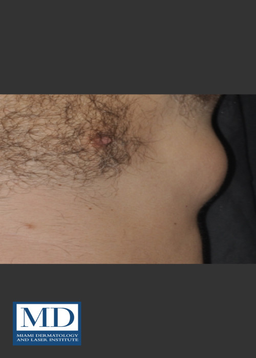 Before Photo for  Body Contouring Treatment 144 - Jill S. Waibel, MD - ZALEA Featured Before & After