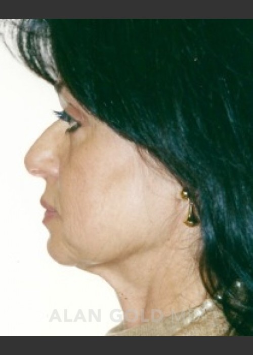 Before Photo for Rhytidectomy (Facelift) 1884 Side View - Alan Gold MD - ZALEA Featured Before & After
