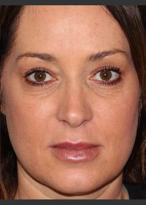 After Photo for Lip Augmentation - Douglas Wu, M.D.  - ZALEA Featured Before & After