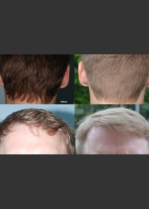 Before Photo for Neograft Hair Transplant - Mark B. Taylor, M.D. - ZALEA Featured Before & After