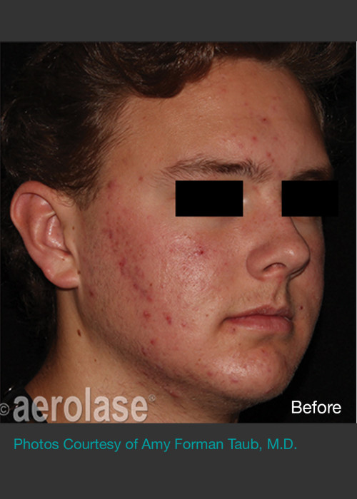 Before Photo for NeoClear by Aerolase Acne Treatment - Amy Forman Taub, MD - ZALEA Featured Before & After