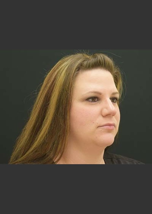 Before Photo for Kybella Double Chin Treatment - Skin Cancer Specialists P.C. & Aesthetic Center - ZALEA Featured Before & After
