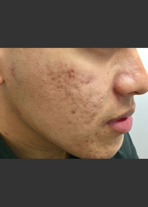 Before Photo for Microneedling  - Janell Ocampo - ZALEA Featured Before & After