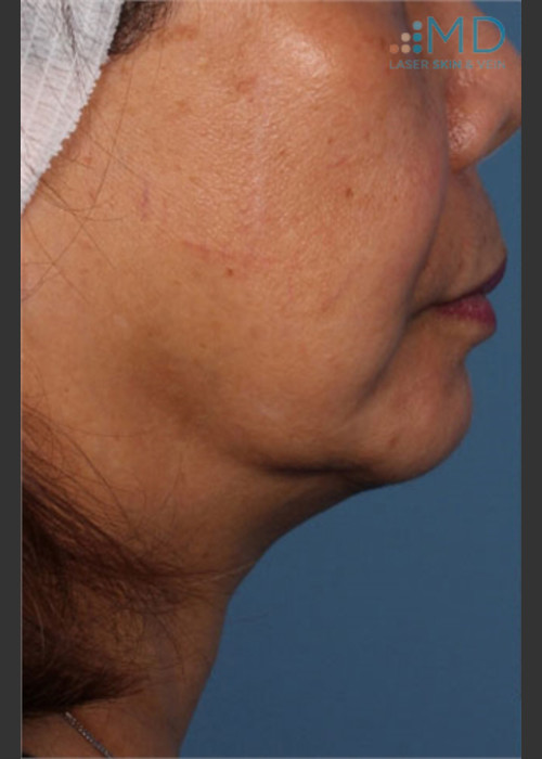 Before Photo for Ultherapy Skin Laxity Treatment of Lower Face - Margaret Ann Weiss - ZALEA Featured Before & After