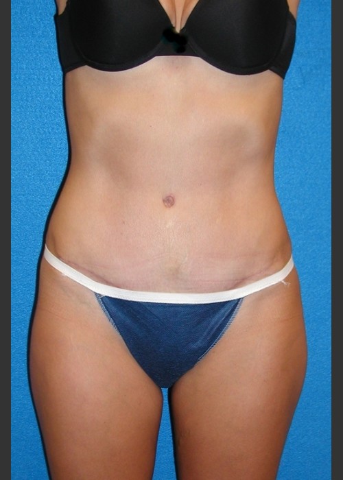 After Photo for Tummy Tuck Case #2 - South Coast Plastic Surgery  - ZALEA Featured Before & After