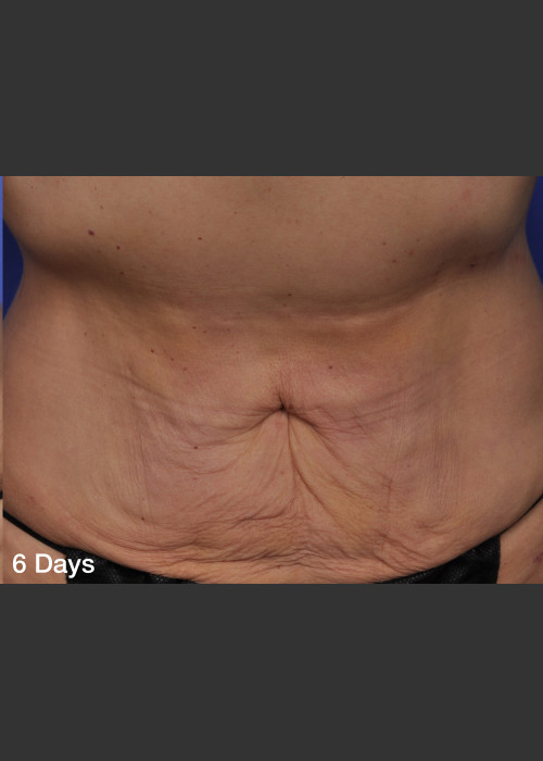 After Photo for ThermiTight Treatment - Barry E. DiBernardo, MD, FACS  - ZALEA Featured Before & After