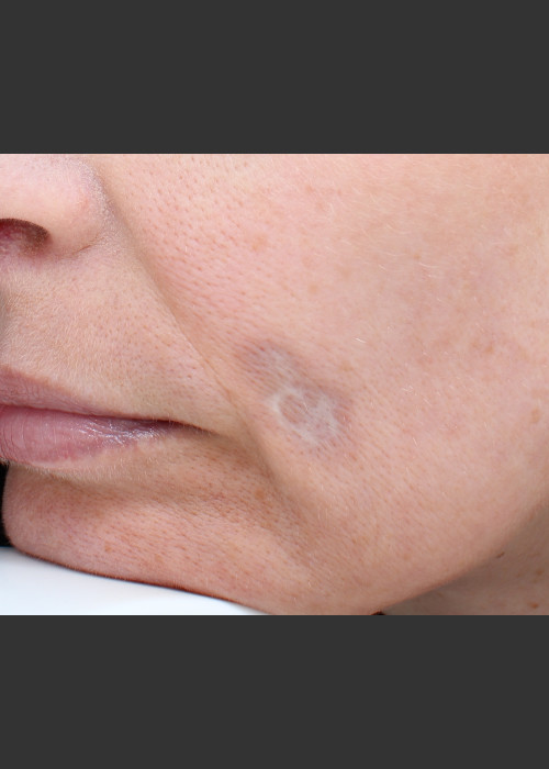 Before Photo for Traumatic scar  - Paul M. Friedman, M.D. - ZALEA Featured Before & After