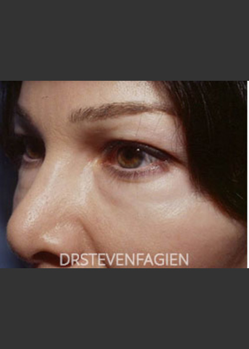 Before Photo for Periorbital Rejuvenation - Patient 7 - Steven Fagien, MD - ZALEA Featured Before & After