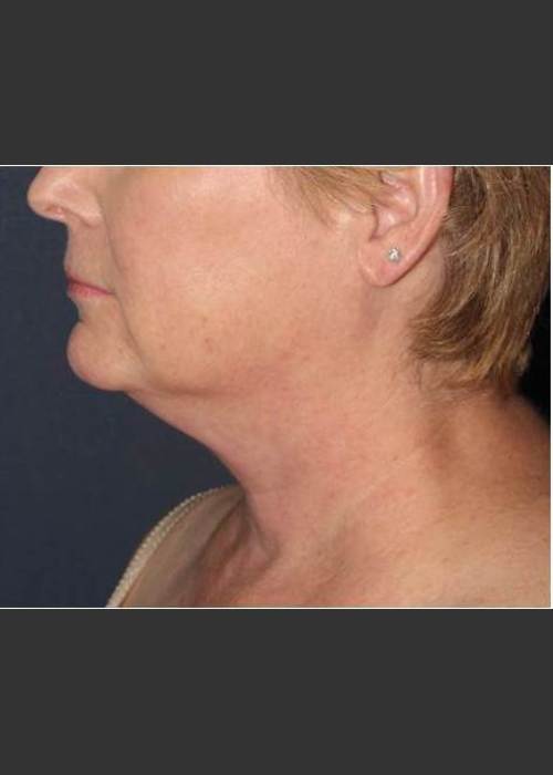 Before Photo for Facial Liposculpture - William F. Groff, M.D. - ZALEA Featured Before & After