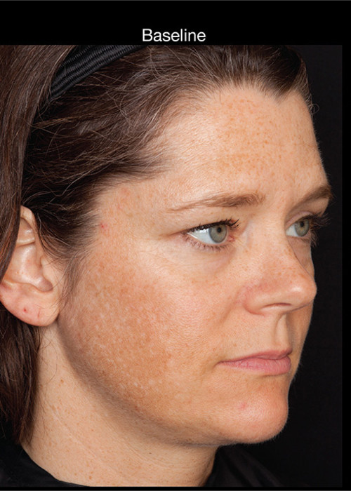 Before Photo for Hyperpigmentation - Professional Peel - Brian S. Biesman, MD - ZALEA Featured Before & After