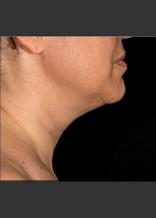 After Photo for SculpSure Submental - Bruce E Katz, M.D.  - ZALEA Featured Before & After