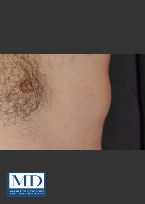 After Photo for  Body Contouring Treatment 144 - Jill S. Waibel, MD  - ZALEA Featured Before & After