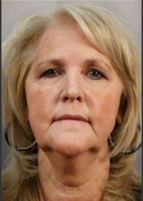 Before Photo for 58 Year Old Female: Facelift - R. Scott Yarish MD, FACS - ZALEA Featured Before & After