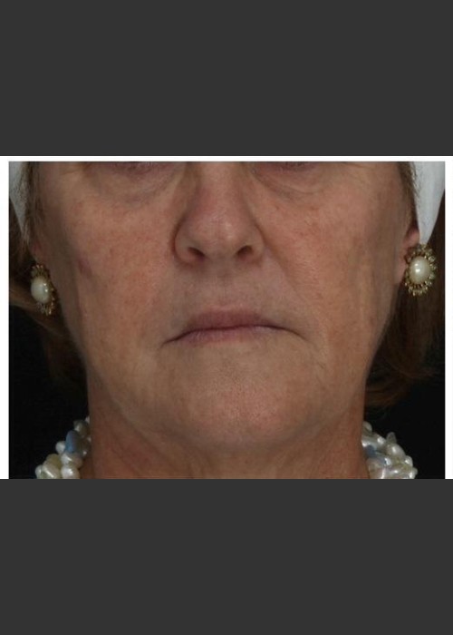 Before Photo for Immediate Lifting of Corners of the Mouth after Juvederm Ultra injection (effect is immediately after injection) - Leyda Elizabeth Bowes, M.D. - ZALEA Featured Before & After