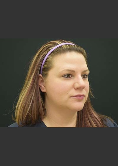 After Photo for Kybella Double Chin Treatment - Skin Cancer Specialists P.C. & Aesthetic Center  - ZALEA Featured Before & After