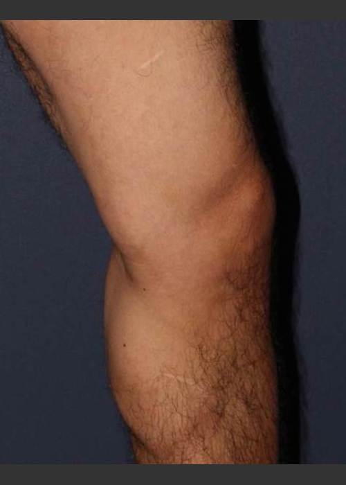 After Photo for Non-surgical Leg Vein Treatment - Mitchel P. Goldman M.D.  - ZALEA Featured Before & After