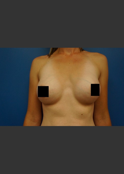 After Photo for Breast Augmentation - Dr. Josh Olson  - ZALEA Featured Before & After