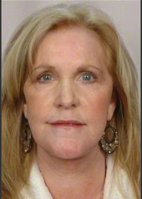 After Photo for 58 Year Old Female: Facelift - R. Scott Yarish MD, FACS  - ZALEA Featured Before & After