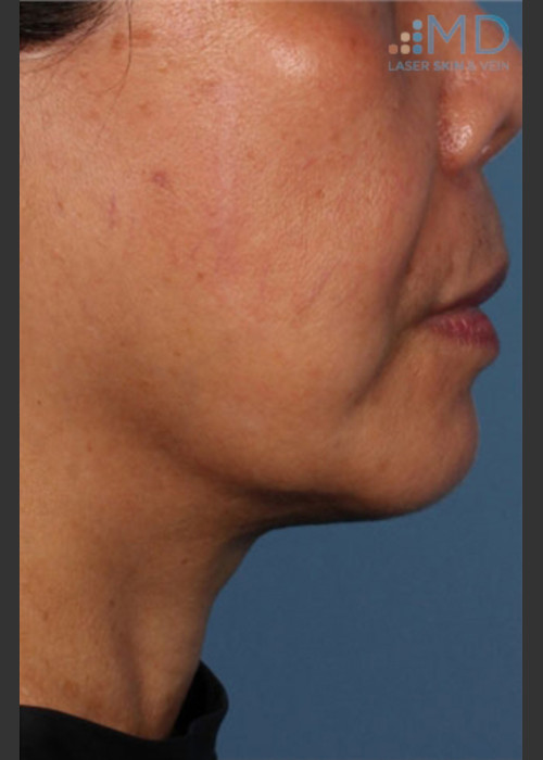After Photo for Ultherapy Skin Laxity Treatment - Robert Weiss, M.D., F.A.A.D., F.A.C.Ph  - ZALEA Featured Before & After