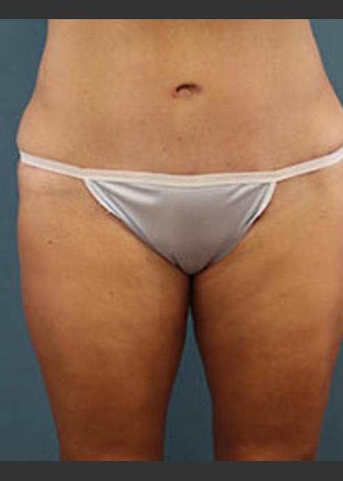 After Photo for Before and After Tummy Tuck - Arthur Handal  - ZALEA Featured Before & After