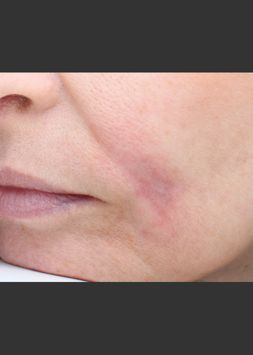 After Photo for Traumatic scar  - Paul M. Friedman, M.D.  - ZALEA Featured Before & After