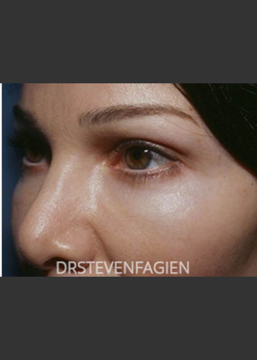 After Photo for Periorbital Rejuvenation - Patient 7 - Steven Fagien, MD  - ZALEA Featured Before & After