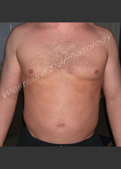 Before Photo for SmartLipo Liposuction of Male Abdomen - Gregory A Nikolaidis - ZALEA Featured Before & After