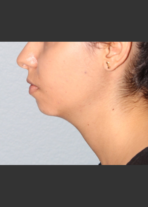 Before Photo for Chin Augmentation - Bryan J. Correa, MD - ZALEA Featured Before & After