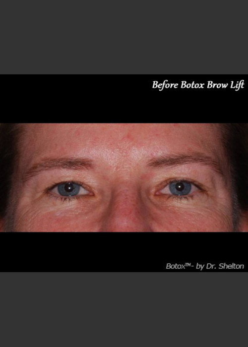 Before Photo for Treatment of Perioral Wrinkles - Ron M. Shelton, M.D. - ZALEA Featured Before & After