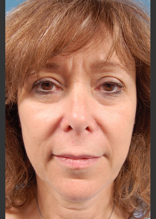 Before Photo for Facelift Surgery - Thomas A. Mustoe, MD, FACS - ZALEA Featured Before & After