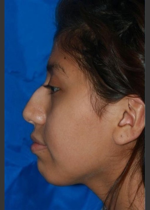 Before Photo for Rhinoplasty - Case 13 - Konstantin Vasyukevich, MD - ZALEA Featured Before & After