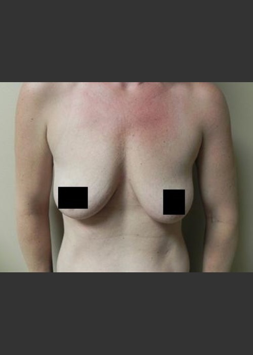 Before Photo for Breast Augmentation - Brian P. Tierney, MD - ZALEA Featured Before & After