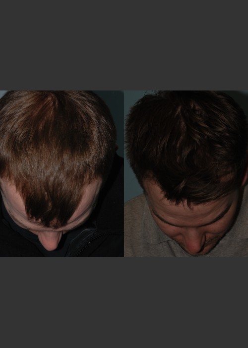After Photo for Neograft Hair Transplant - Mark B. Taylor, M.D.  - ZALEA Featured Before & After