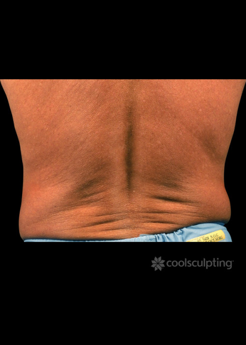 Before Photo for CoolSculpting on Man Flanks (Love Handles) - W. Grant Stevens, MD, FACS - ZALEA Featured Before & After
