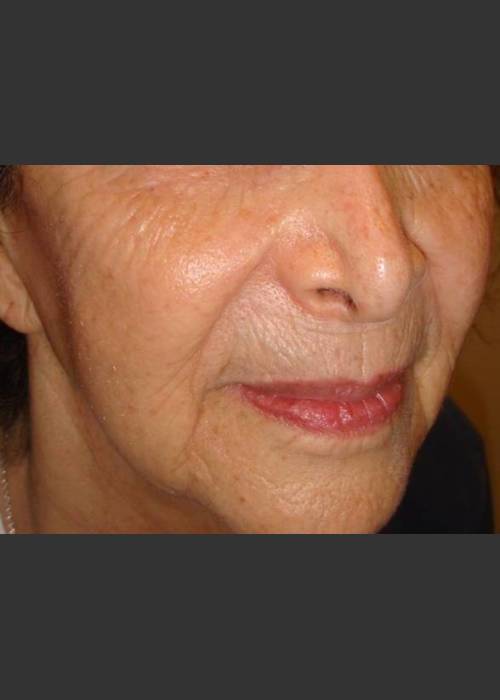 After Photo for Rejuvenating devices sun damaged skin - Christopher B. Zachary, MD  - ZALEA Featured Before & After