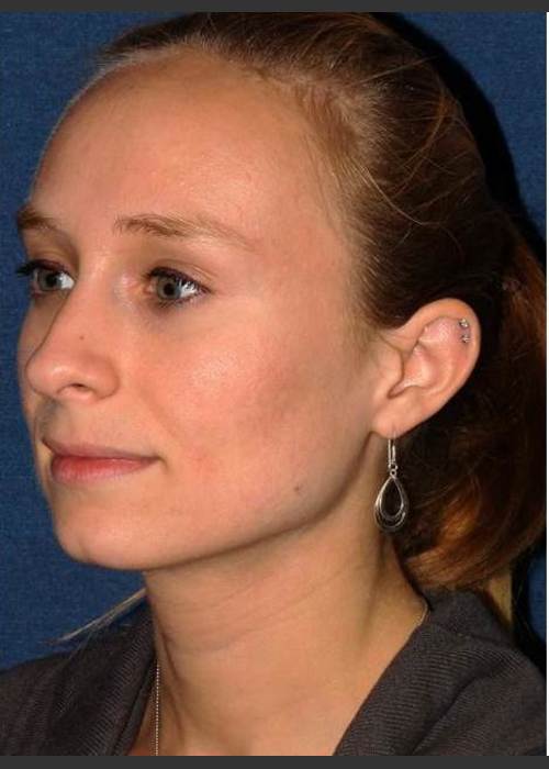 After Photo for Facial Acne Treatment - Dr. Sabrina G. Fabi  - ZALEA Featured Before & After