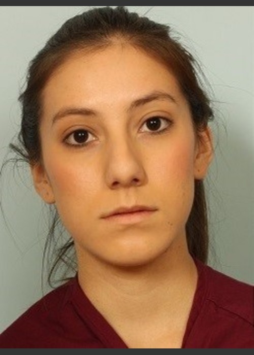 Before Photo for Rhinoplasty Surgery - El Paso Cosmetic Surgery - ZALEA Featured Before & After