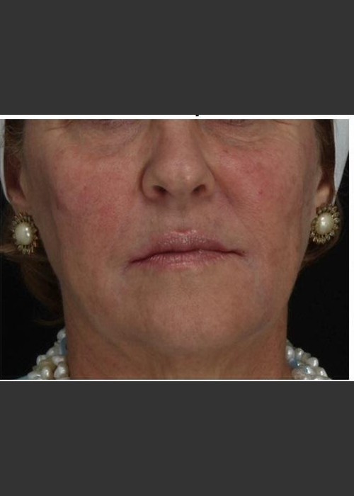 After Photo for Immediate Lifting of Corners of the Mouth after Juvederm Ultra injection (effect is immediately after injection) - Leyda Elizabeth Bowes, M.D.  - ZALEA Featured Before & After