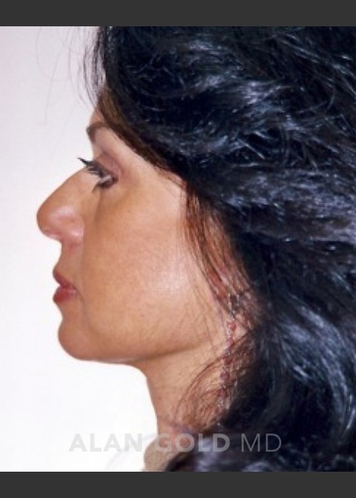 After Photo for Rhytidectomy (Facelift) 1884 Side View - Alan Gold MD  - ZALEA Featured Before & After