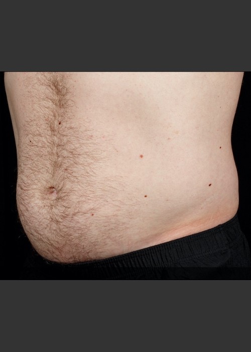 After Photo for SculpSure Abdomen - Sean Doherty  - ZALEA Featured Before & After