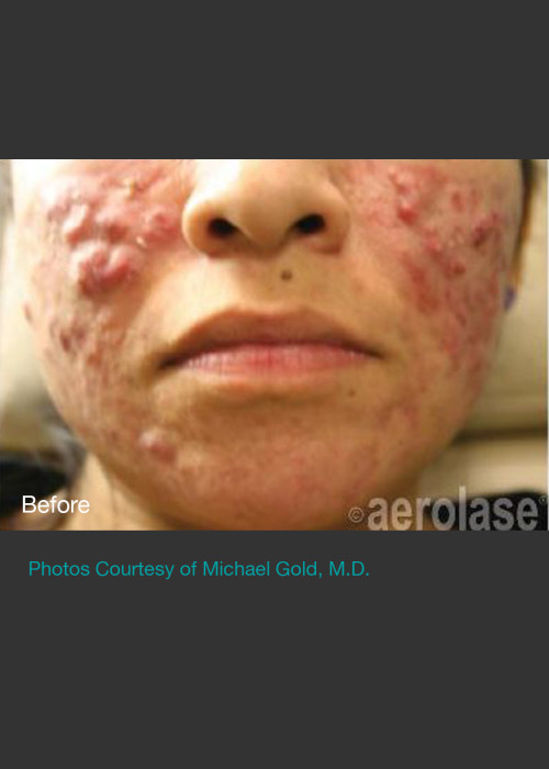 Before Photo for NeoClear by Aerolase Acne Treatment - Michael H Gold - ZALEA Featured Before & After
