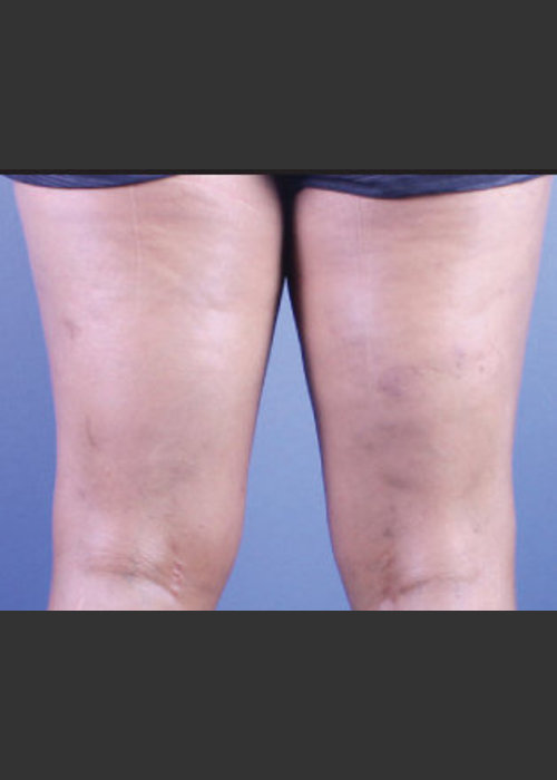 After Photo for Sclerotherapy Treatment for Varicose Veins - Daniel Friedmann   - ZALEA Featured Before & After
