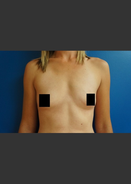 Before Photo for Breast Augmentation - Dr. Josh Olson - ZALEA Featured Before & After