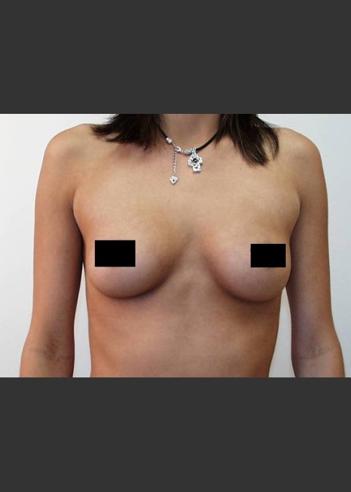 Before Photo for Breast Augmentation - Braden C. Stridde, M.D. - ZALEA Featured Before & After