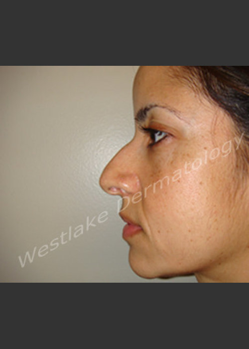 Before Photo for Rhinoplasty Treatment of Female Patient - Cameron Craven MD FACS - ZALEA Featured Before & After