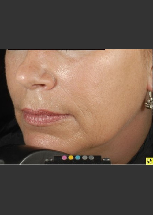 After Photo for Botox Dermal Fillers and Pigment Removal  - Brian D. Zelickson, M.D.  - ZALEA Featured Before & After