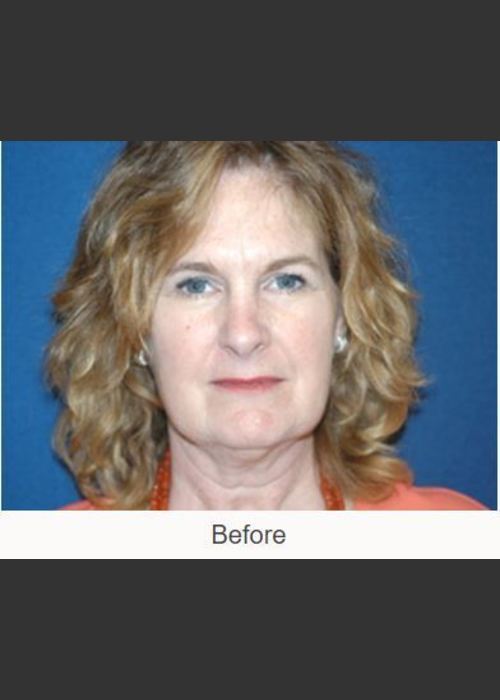 Before Photo for Facelift - Case #23 Details - James N. Romanelli, MD, FACS - ZALEA Featured Before & After