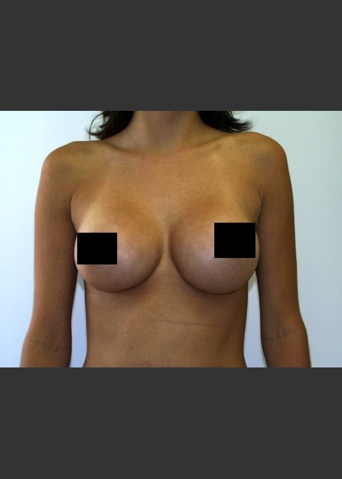 After Photo for Breast Augmentation - Braden C. Stridde, M.D.  - ZALEA Featured Before & After
