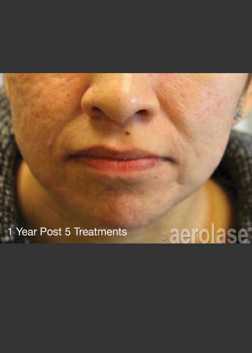 After Photo for NeoClear by Aerolase Acne Treatment - Michael H Gold  - ZALEA Featured Before & After