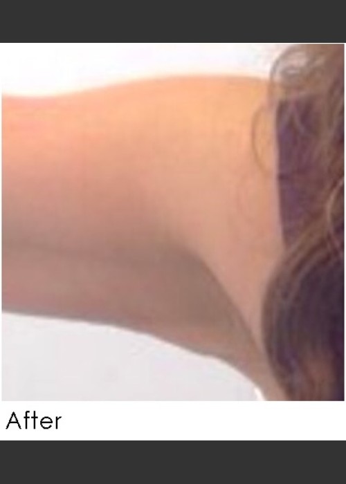 After Photo for Sculptra for Arm Laxity  - Annie Chiu, MD  - ZALEA Featured Before & After